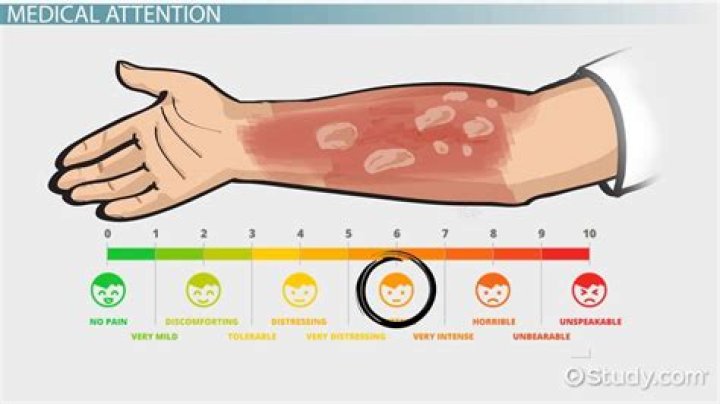 180 degree water burn