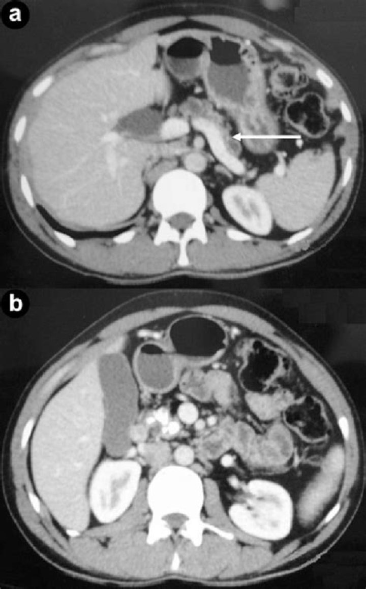 atrophic pancreas