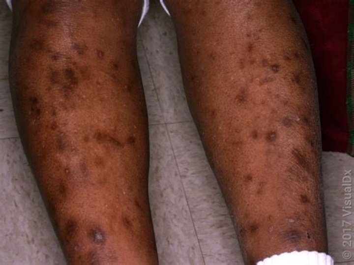 bed bugs black spots