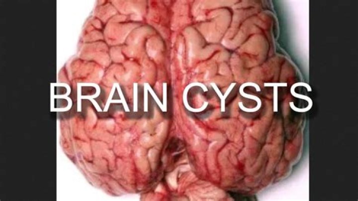 can a cyst on the brain kill you