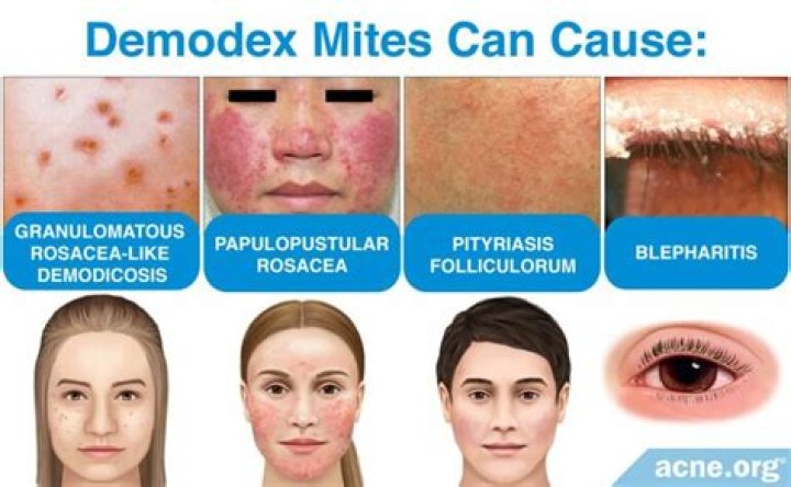 can demodex mites live in bedding