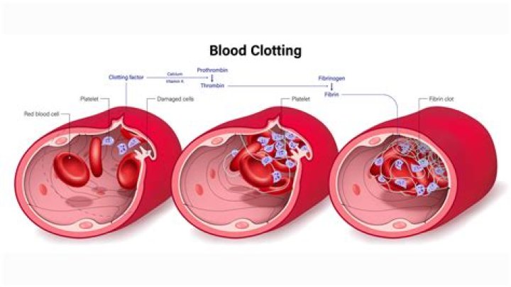 can donating plasma cause blood clots