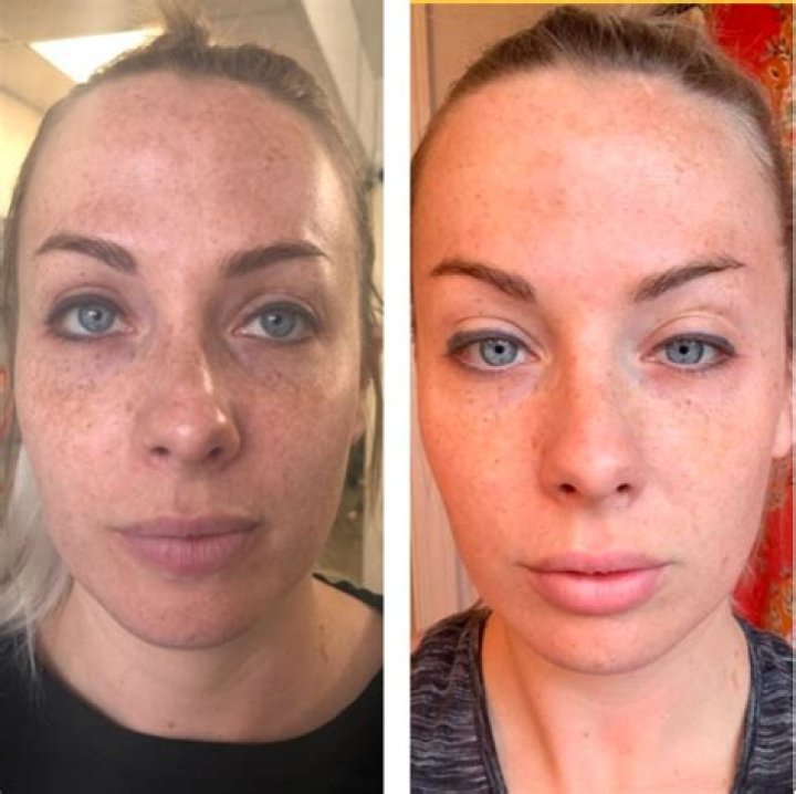 can estheticians do micro needling in california