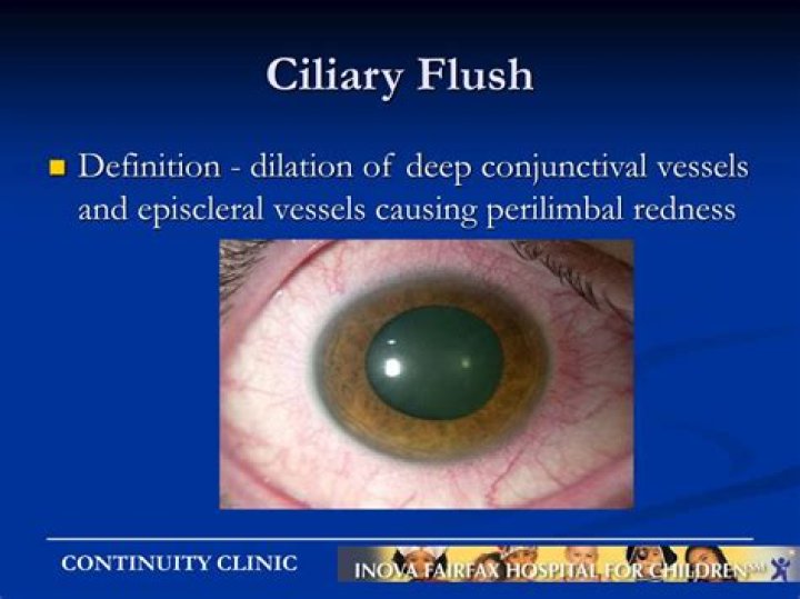 ciliary flush