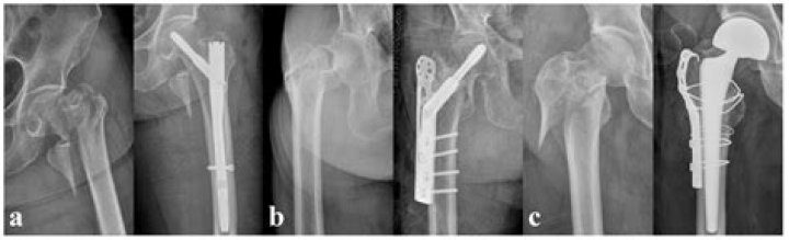 cmn surgery