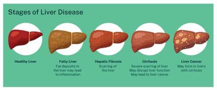 coarse liver