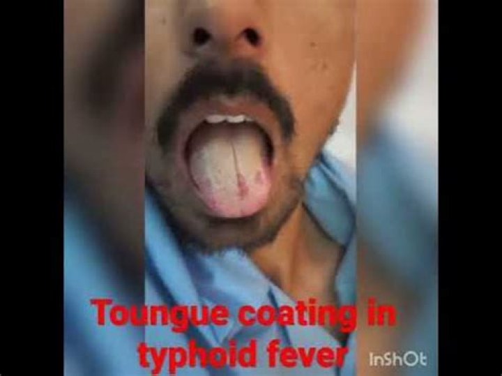 coated tongue in typhoid