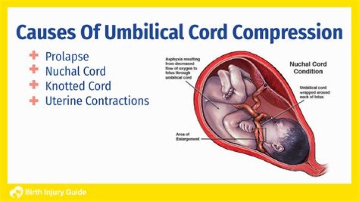 cord avulsion