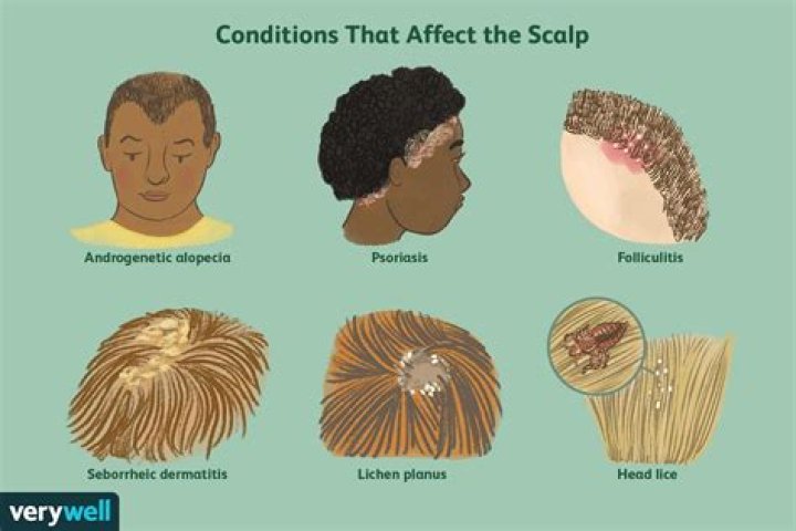 disease of the hair medical term