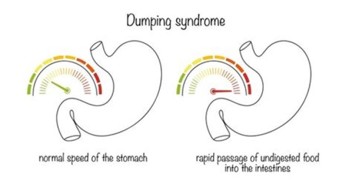 dumping syndrome without surgery