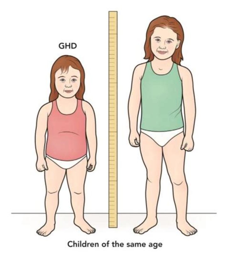 dwarfism effect of hormonal imbalance