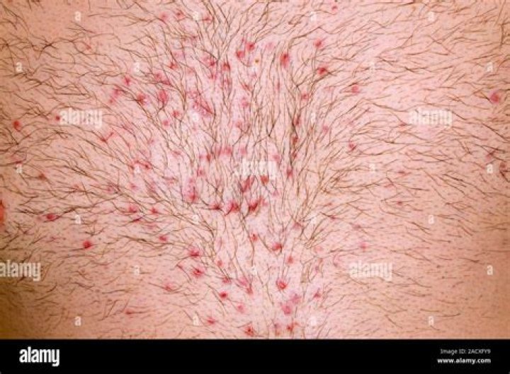 enlarged hair follicles on breast