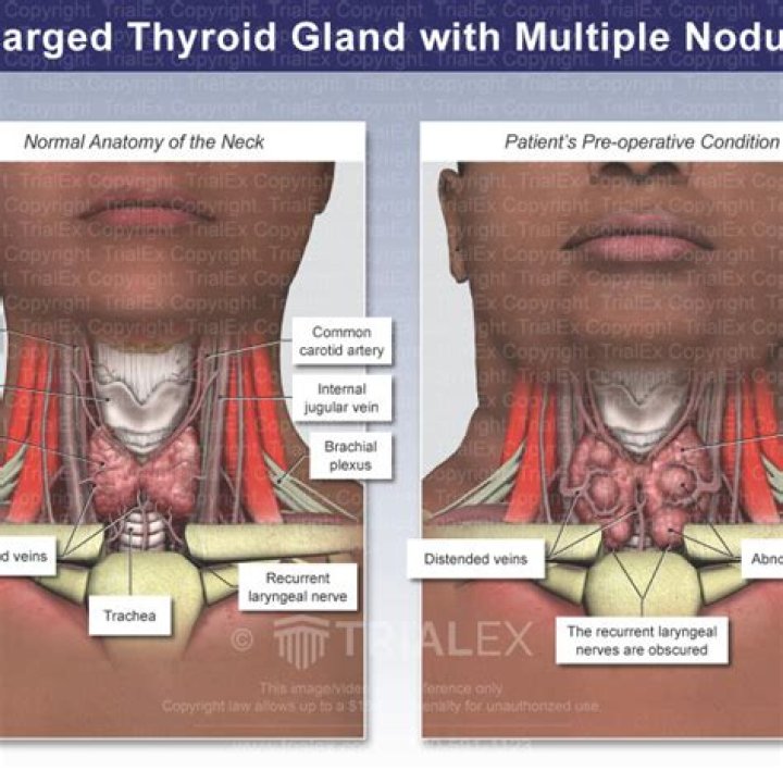 enlarged thyroid icd 10