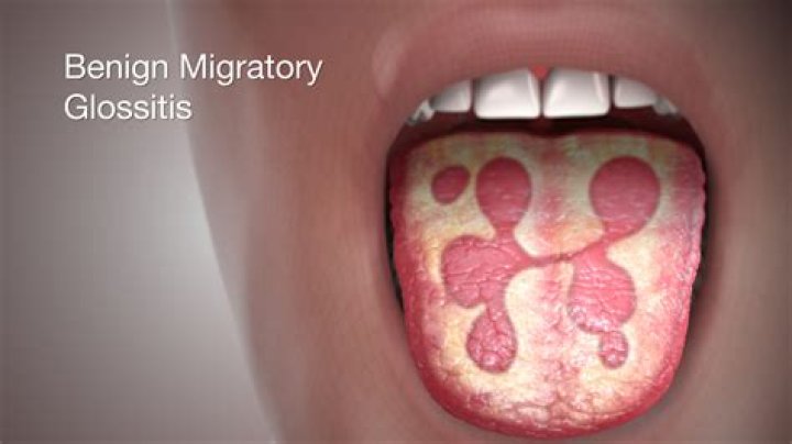 gloss- medical term