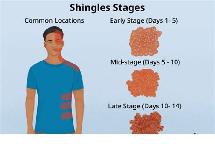 how long does shingles live on surfaces