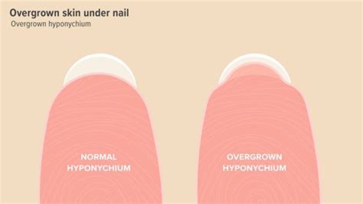 hyponychium damage