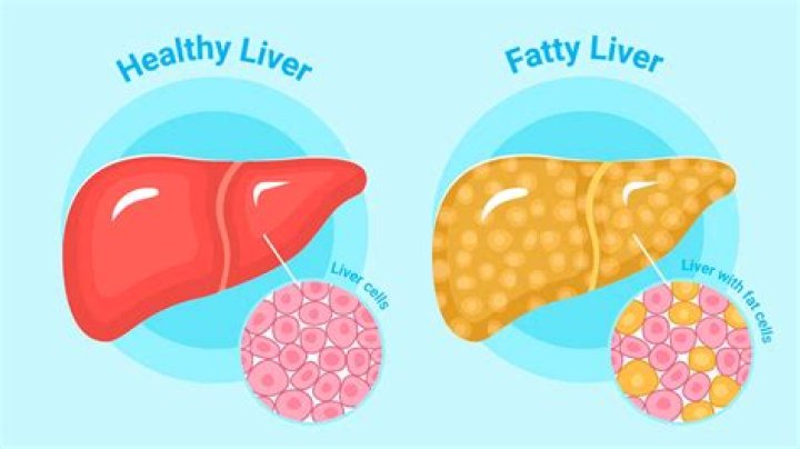 is aleve bad for your liver