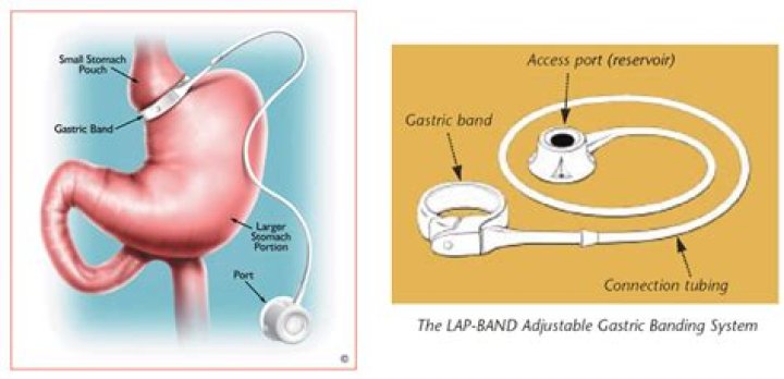 lap band adjustment cpt code