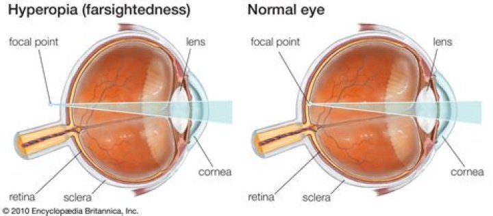 latent hyperopia