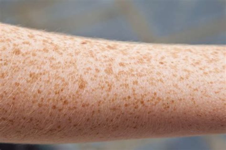 medical term for freckles