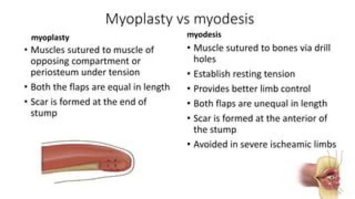 myodesis