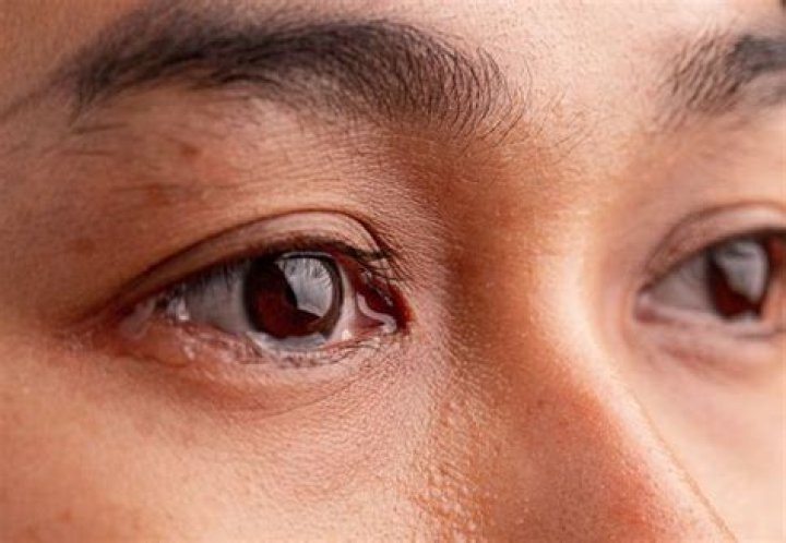 rheumy eyes