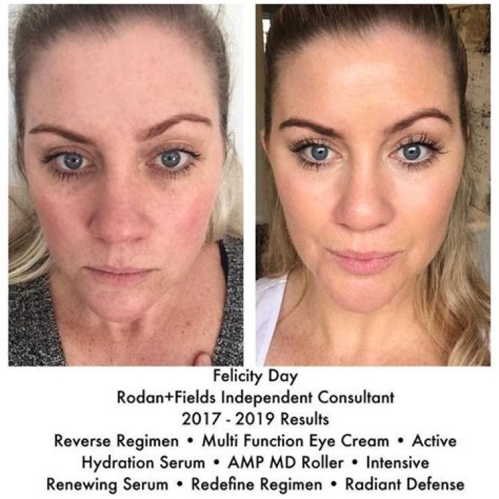 rodan and fields reverse causing breakouts