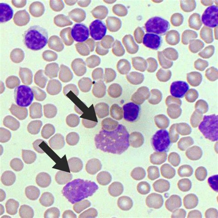 smudge cells present