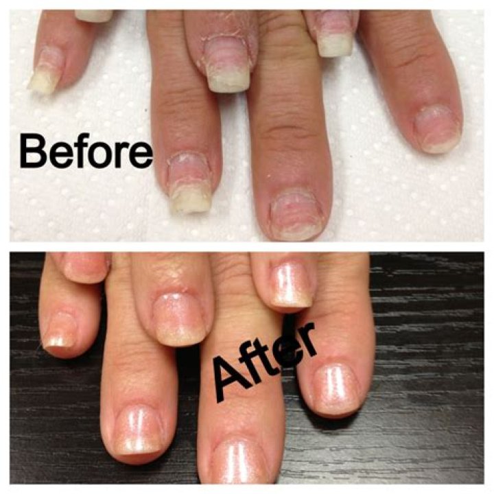 stepped on a nail treatment