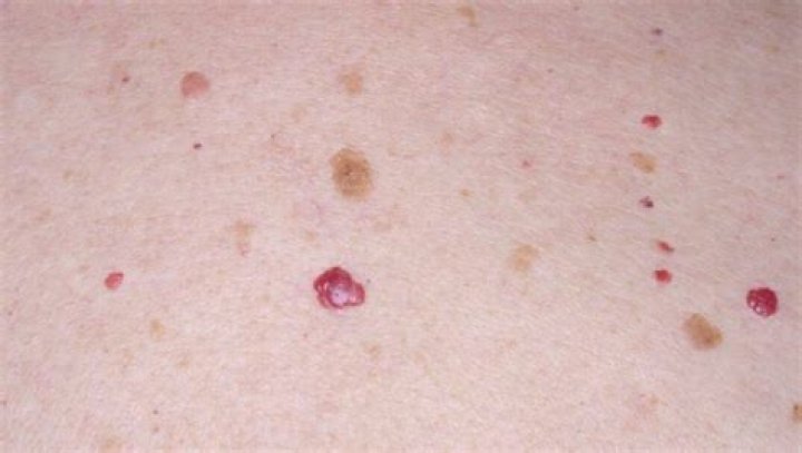 sudden appearance many cherry angiomas