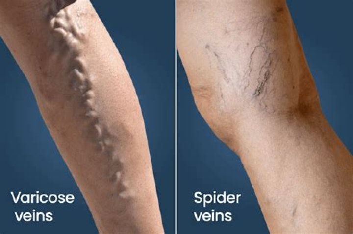 swollen twisted veins near the testes