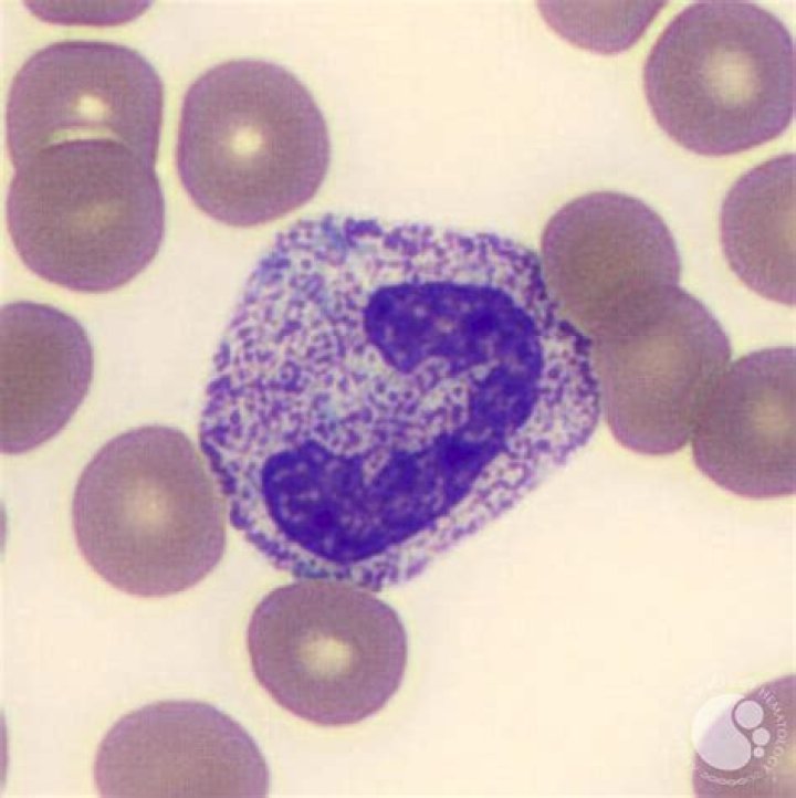 toxic granulation present